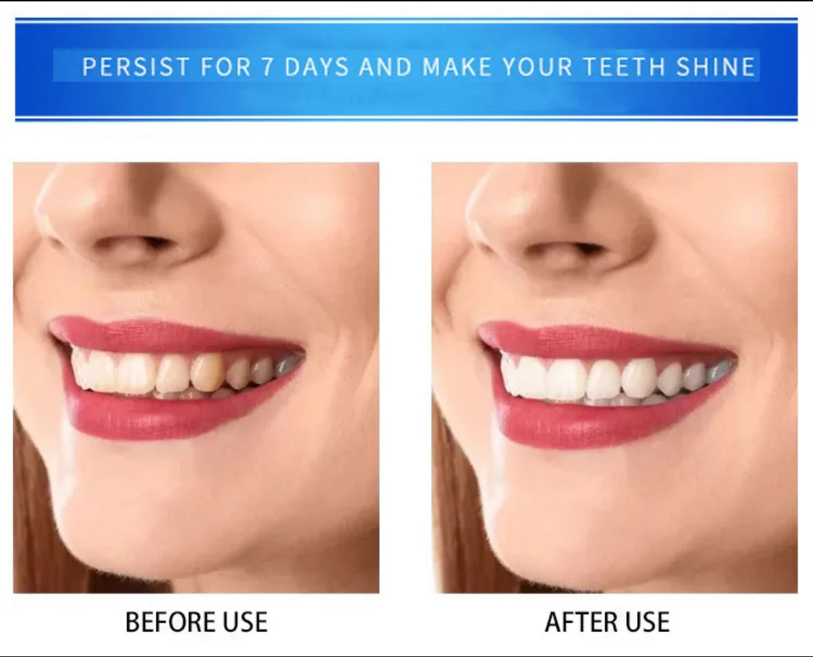 Teeth Whitening Kit